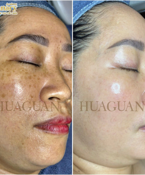 WOONG HYE - PIGMENT REMOVAL -  ĐÀO THẢI SẮC TỐ