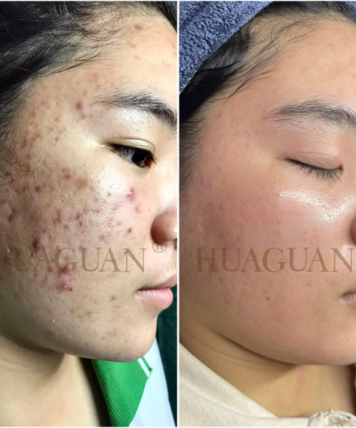 WOONGHYE - SKIN DOCTOR ACNE SERUM 