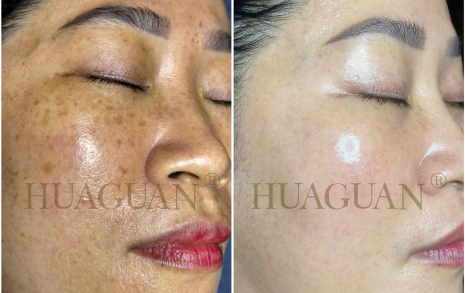 WOONG HYE - PIGMENT REMOVAL -  ĐÀO THẢI SẮC TỐ