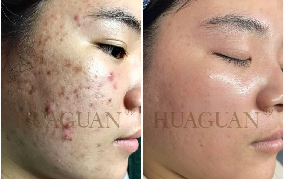 WOONGHYE - SKIN DOCTOR ACNE SERUM 